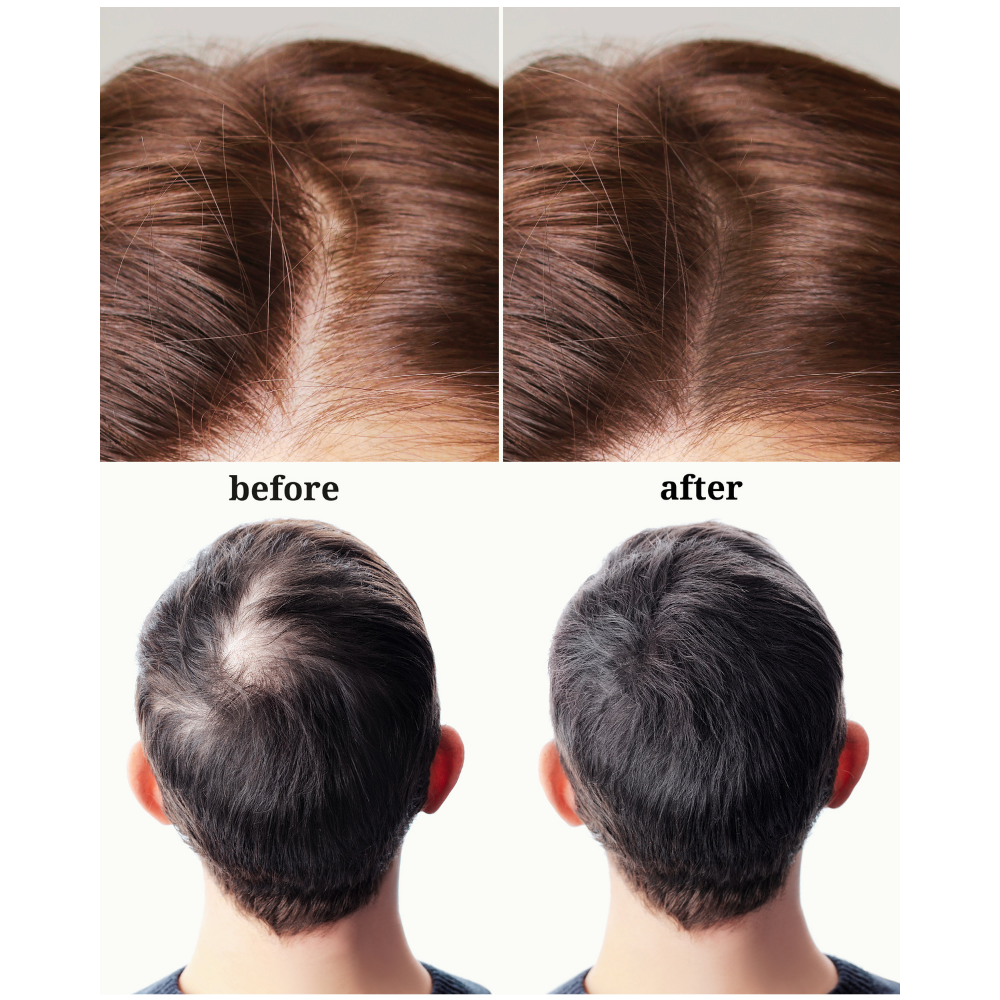 Crown Confidence Cap - Red Light Therapy Hair Regrowth